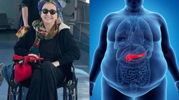 Neoplasia al pancreas, la patologia che ha colpito Enrica Bonaccorti: ecco i sintomi a cui fare attenzione