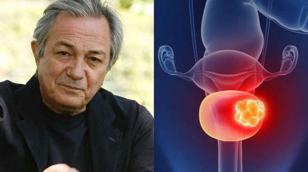 Neoplasia alla vescica, la patologia che ha colpito Remo Girone: ecco i sintomi a cui fare attenzione
