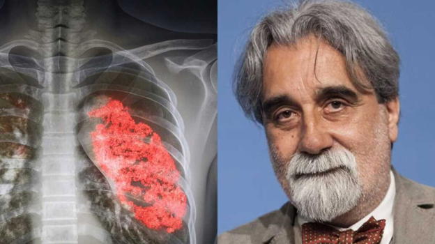 Beppe Vessicchio, polmonite interstiziale: cos’è e quali sono i sintomi