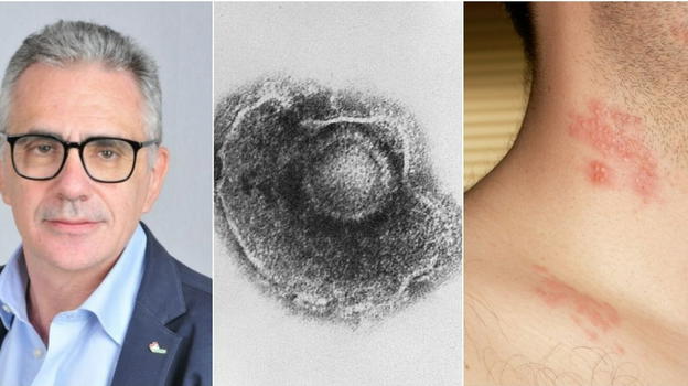 Fuoco di Sant’Antonio, Pregliasco: "Attenzione agli occhi, ecco perché"