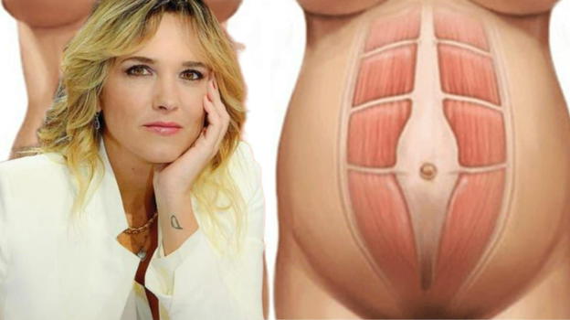Diastasi, la malattia che ha colpito Francesca Barra: i sintomi a cui prestare attenzione