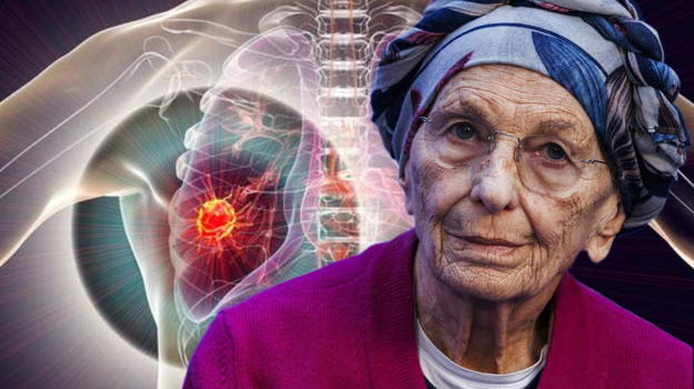 Microcitoma, la patologia che ha colpito Emma Bonino: i sintomi a cui prestare attenzione