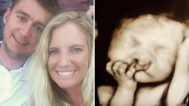 Medico: "Abortite, il bambino è deformato". I genitori rifiutano: ecco com’è diventato oggi il bimbo