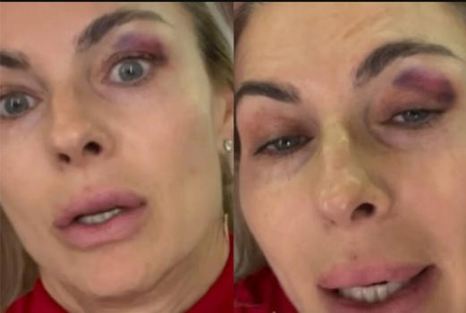 Martina Colombari con un occhio completamente nero: "È stat…"