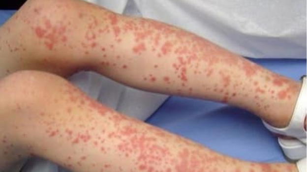 Donna si riempie di macchie, il motivo è orribile: "Ha fatto…