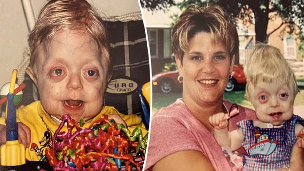 Gli davano 18 mesi di vita. Oggi ha 22 anni: guardalo ora