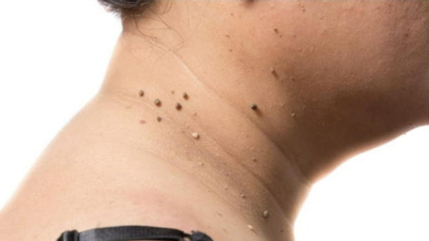 Papillomi cutanei: ecco 4 modi per eliminarli naturalmente