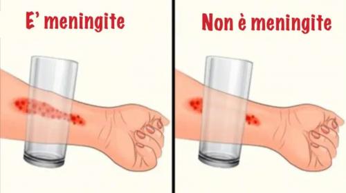 Ecco 8 sintomi della meningite che ogni genitore dovrebbe conoscere