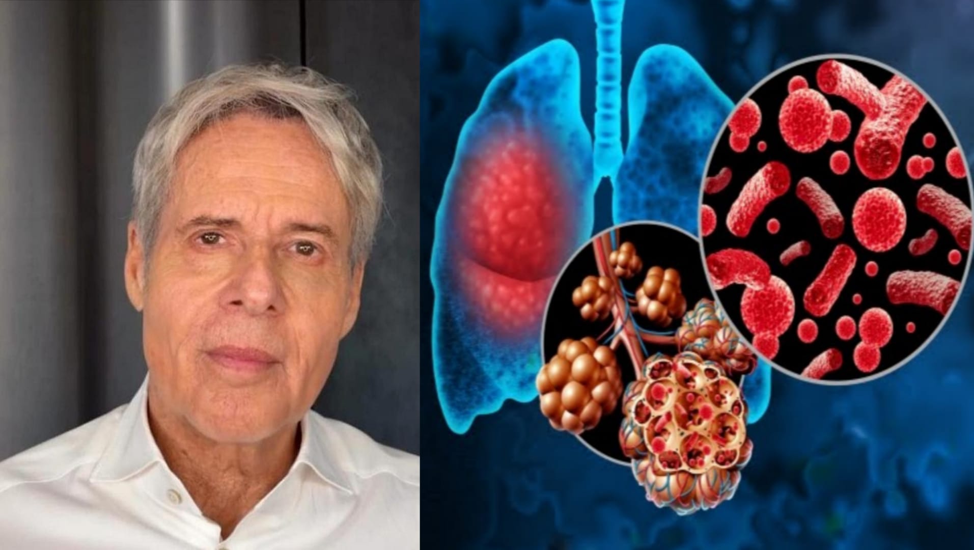 Polmonite interstiziale, la malattia che ha colpito Claudio Baglioni: i sintomi da non sottovalutare